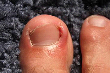 ingrown toenails