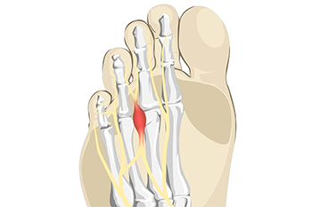 neuroma morton s