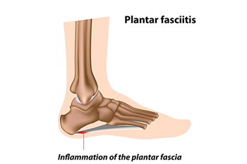 plantar fasciitis