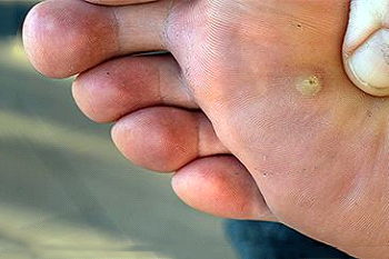 plantar warts