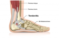 Where Is the Achilles Tendon?