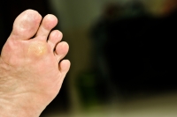 Causes and Effective Treatment of Plantar Warts