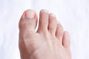 How to Tell if an Ingrown Toenail Is Infected