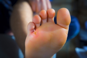 A Podiatrist Can Provide Relief for Corn Pain
