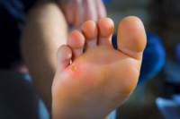 A Podiatrist Can Provide Relief for Corn Pain