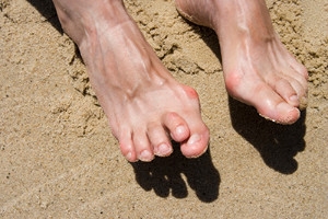 Hammertoe and Overlapping Toes