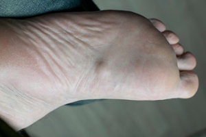 Understanding Lederhose Disease