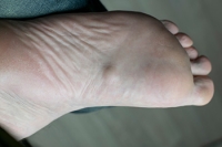 Understanding Lederhose Disease